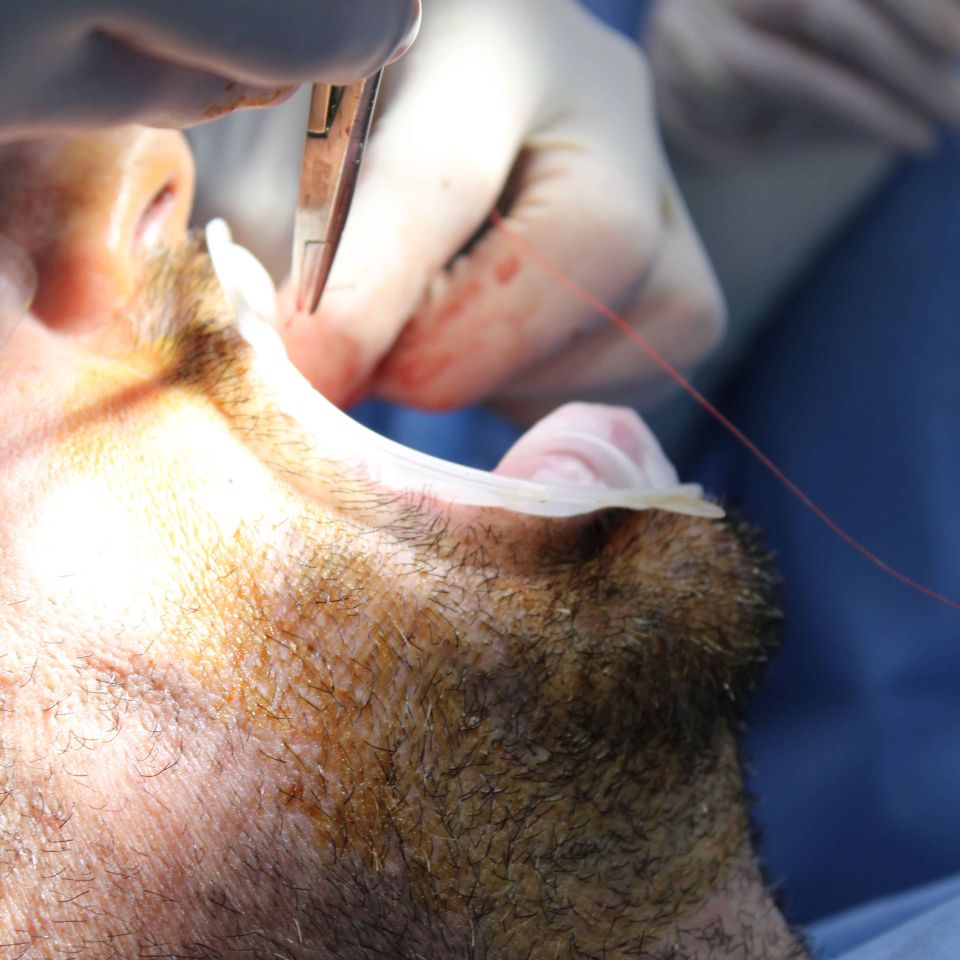 Gloved hands using surgical forceps and suture thread on a male patient's mouth during a dental surgical procedure