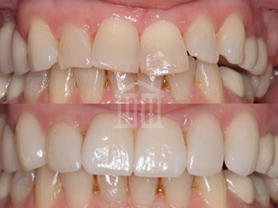 Before and after dental crowns treatment showing stained, uneven teeth transformed into uniform, whiter teeth