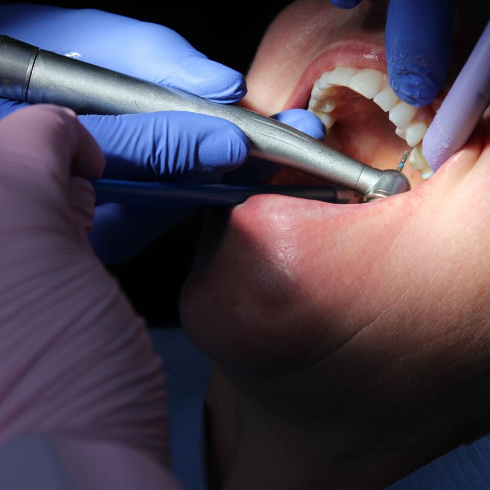 Dentist in blue gloves applying composite bonding to a patient's teeth using a dental handpiece