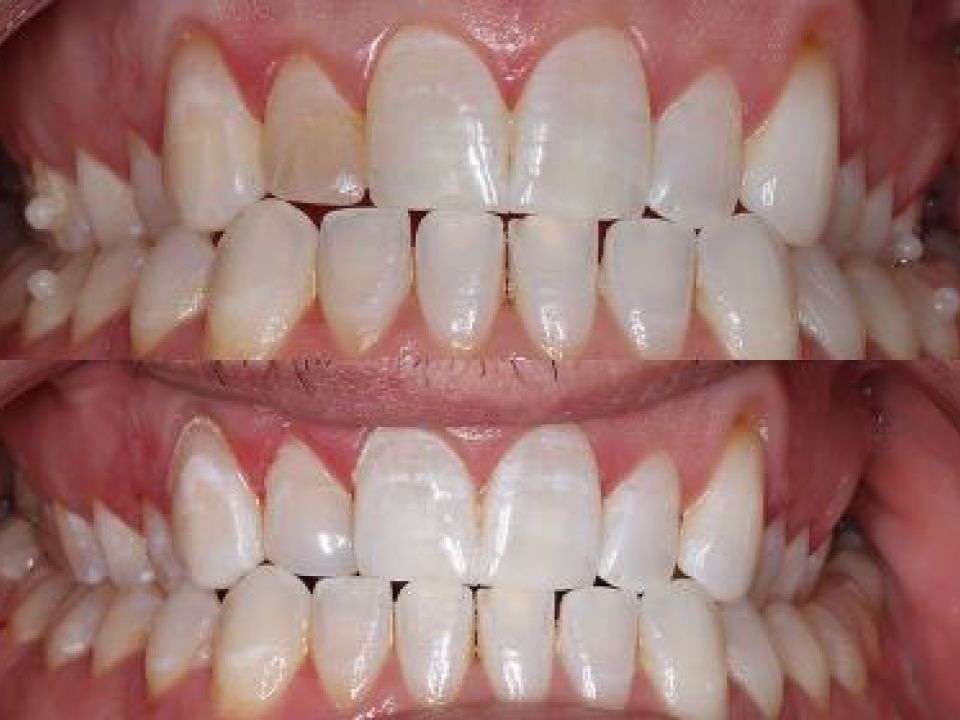 Before and after teeth whitening treatment showing visibly brighter, whiter teeth in the lower panel
